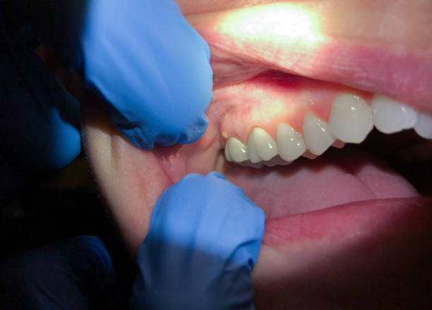 Best Emergency Gum Treatment in Smithville, OH